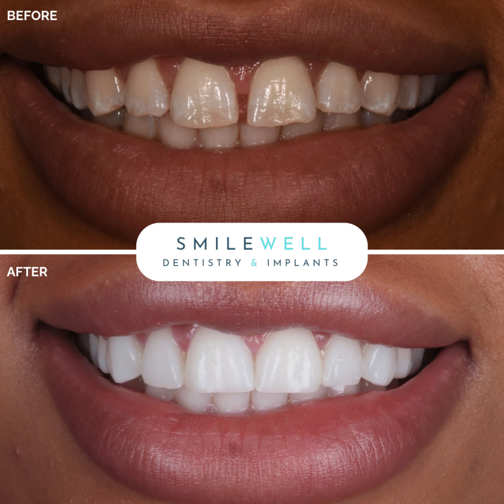 London_Implant_Clinic_Veneers1