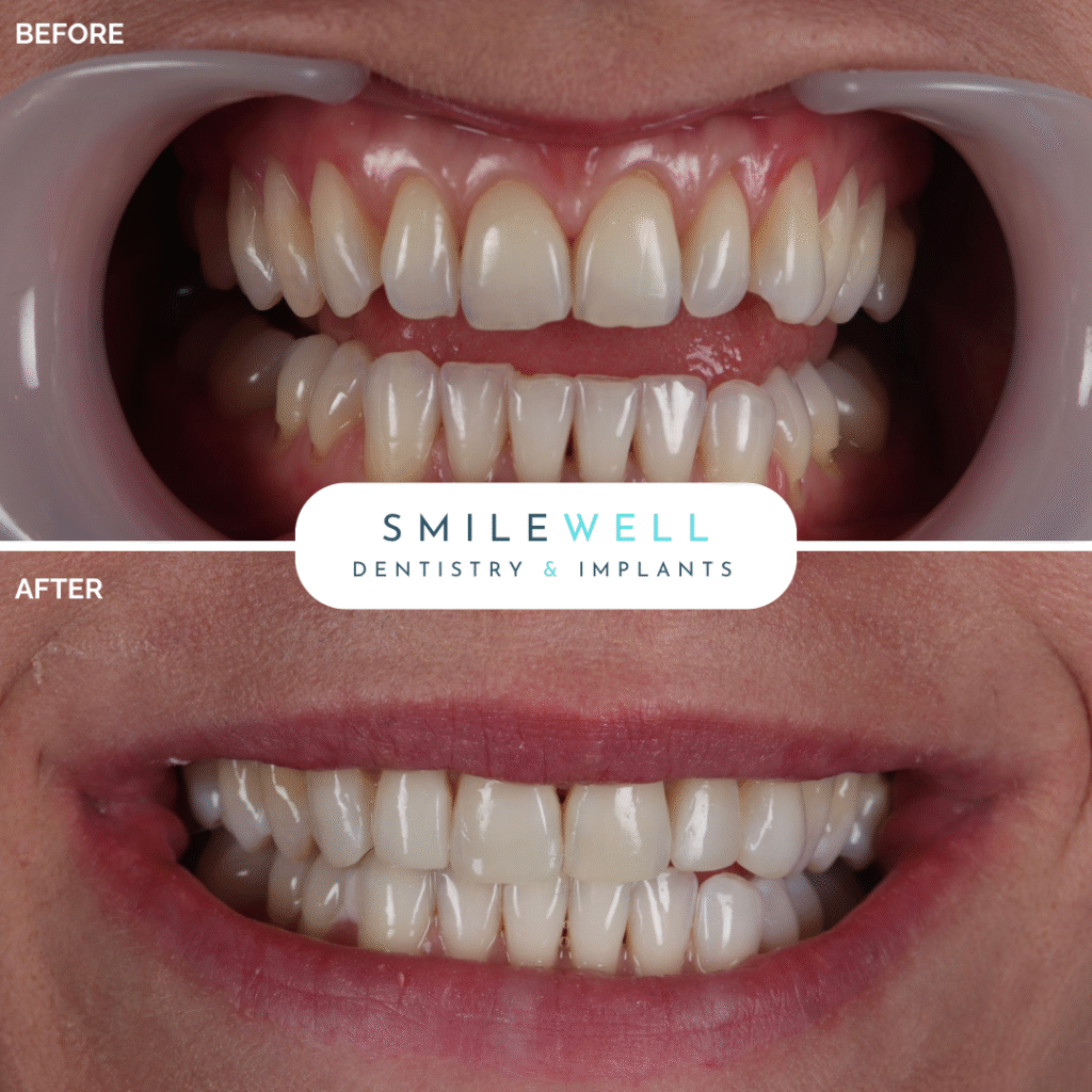 London_Implant_Clinic_Veneers2.png