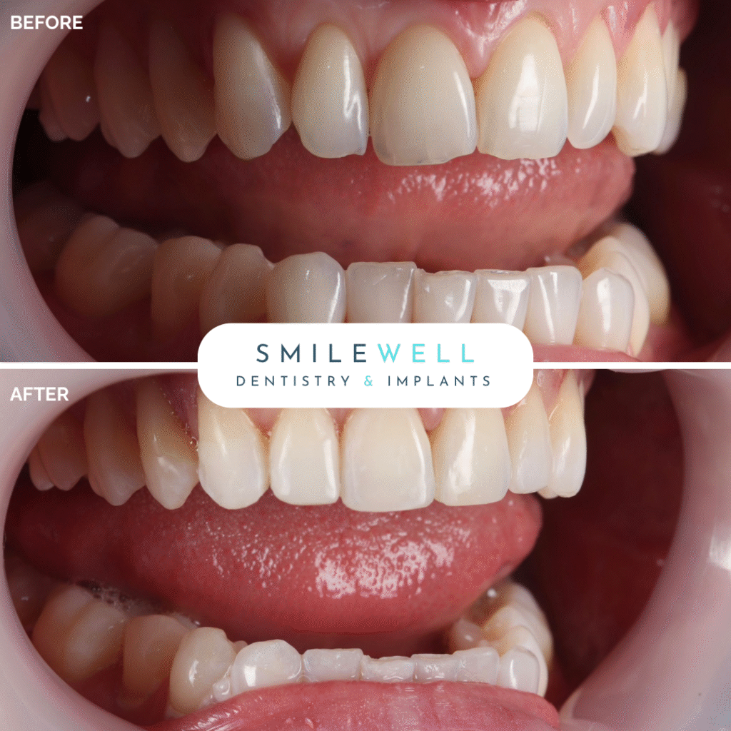 London_Implant_Clinic_Veneers3.png