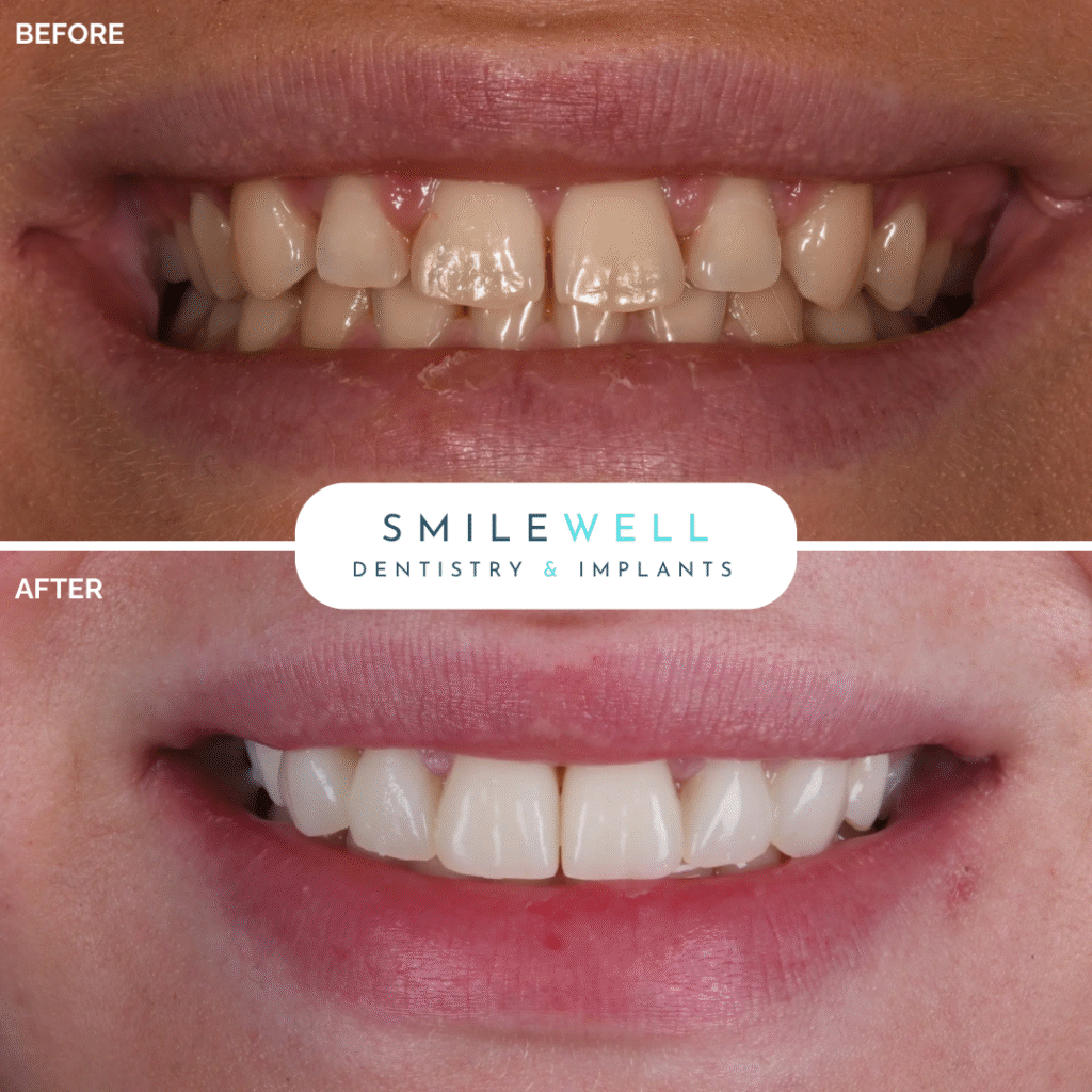 London_Implant_Clinic_Veneers4