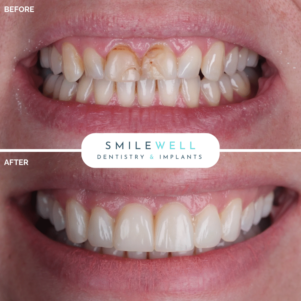 London_Implant_Clinic_Veneers5.png